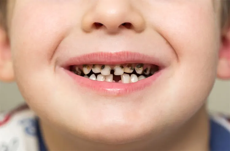 کاربرد اوزون در پیشگیری از پوسیدگی دندانی