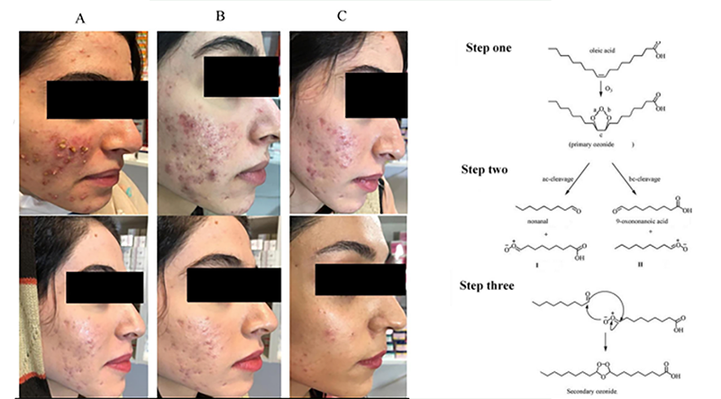 Formulation and clinical evaluation of ozonated olive oil for the treatment of acne vulgaris lesions